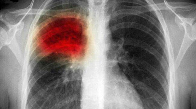 Akciğer Kanserlerinin %20'sinde Tedavi Mümkün!