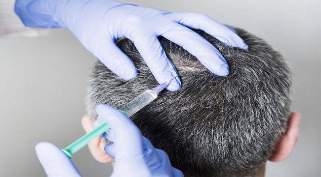 Yaz Aylarında Yıpranan Saçlara Etkili Çözüm: Saç Mezoterapisi