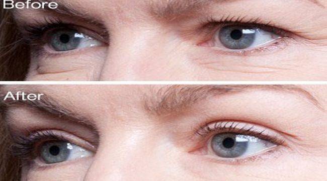 Göz kapağı sarkması tedavi edilebilir